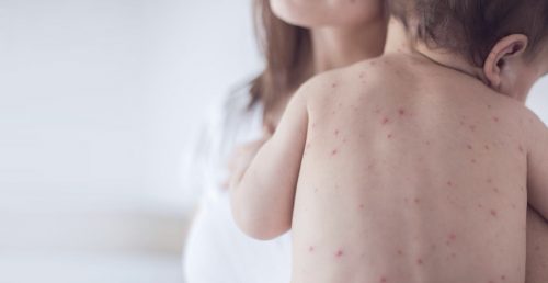 Վերջին մեկ շաբաթում կարմրուկի հաստատված դեպքերի թիվն ավելացել է 11-ով՝ հասնելով 384-ի