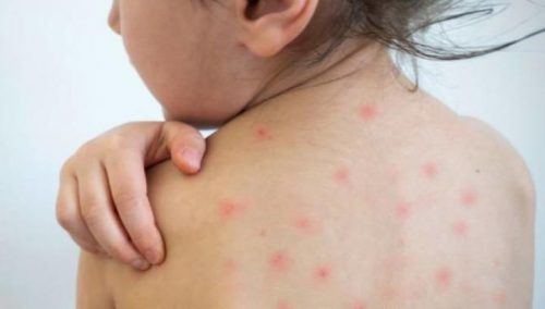 415 measles cases reported in Armenia