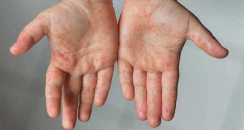 Laboratory-confirmed cases of measles in Armenia increase by 7