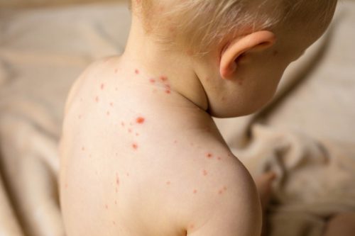 475 measles cases reported in Armenia