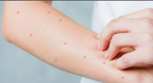 Анаит Аванесян: Мы сможем внедрить в Армении вакцину от оспы