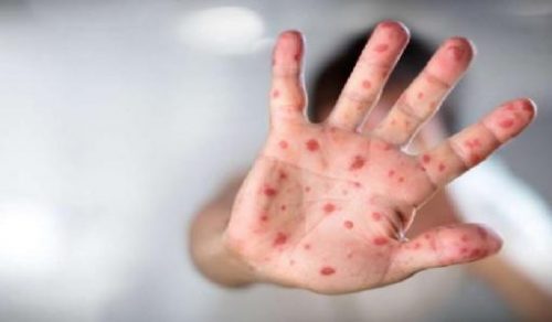 Laboratory tests confirm 494 measles cases