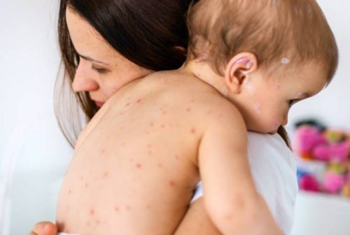 Число лабораторно подтвержденных случаев кори в Армении достигло 500