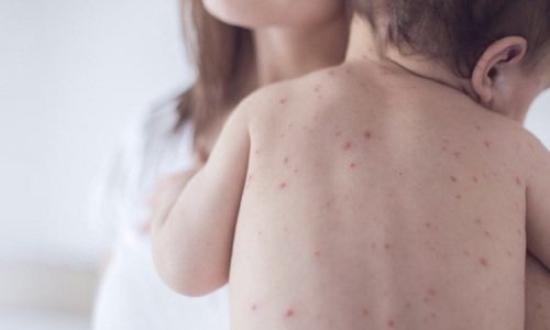 Measles cases in Armenia reach 508