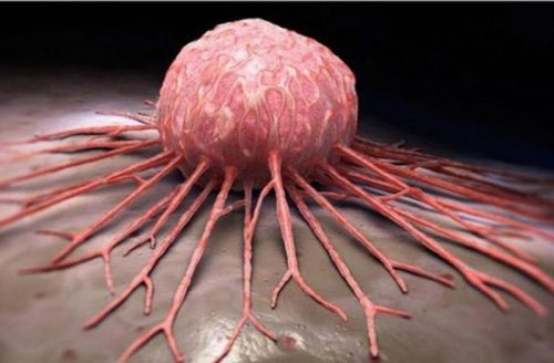 Наиболее распространенные виды рака в Армении