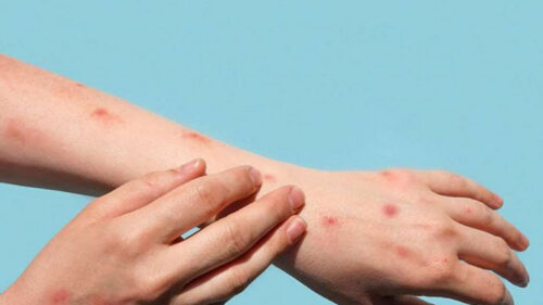 Կապիկի ծաղիկը հասավ Հնդկաստան